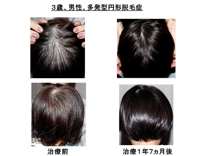 円形脱毛症　病院